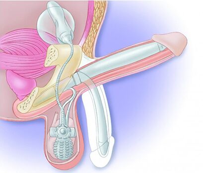 Varpos protezas atkurs erekciją ir padidins varpą
